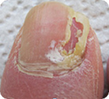Symptome von Nagelpilzbefall sind:  Brüchigkeit der Nägel, "Lochfraß" und Ablösung einzelner Nagelschichten, weiße Streifen oder Flecken, weißliche bis gelblich-braune Verfärbungen, Verdickung der Nagelplatte, entzündetes Nagelbett.